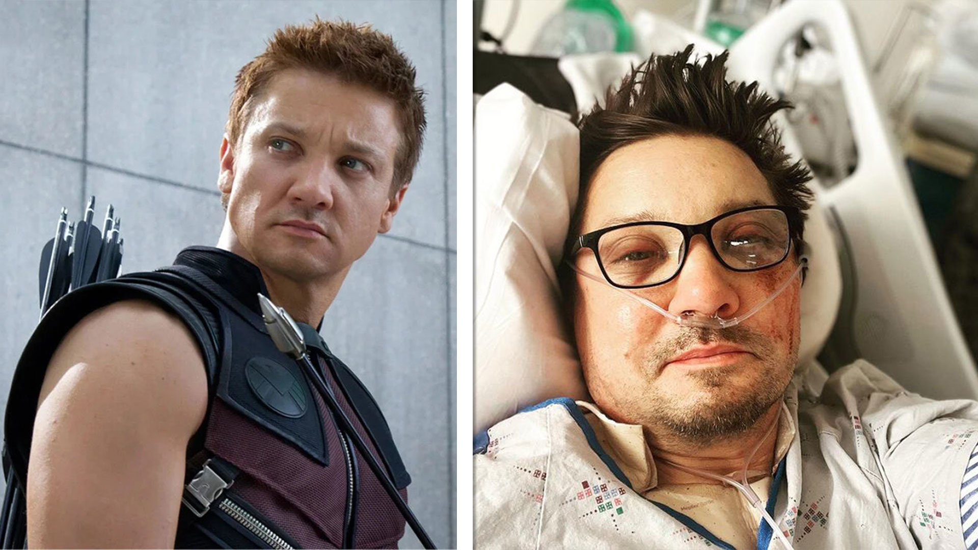 Did jeremy renner have an amputation
