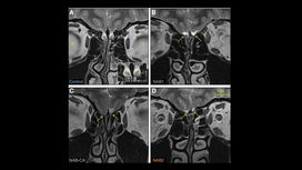 МРТ-сканирование выявило явные различия в строении мозга людей с обонятельными луковицами (слева вверху) и без них (внизу и справа вверху).