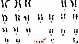 Биоинженеры смогли выключить хромосому, ответственную за синдром Дауна