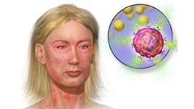 Особые антитела остановят аллергию до её проявления