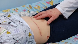 Челябинские врачи удалили огромную опухоль на печени у 15-летнего подростка