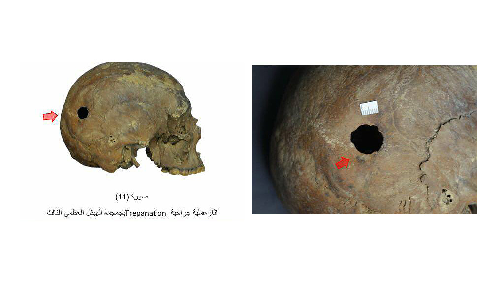 Отверстие в черепе третьего мужчины из черного саркофага. Фото: Egypt Ministry of Antiquities