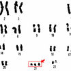 Синдром Дауна является следствием появления лишней третьей копии 21-й хромосомы 