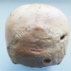 Переломы черепа, возможно, нанесённые камнями, выпущенными из пращи.