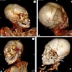 КТ-снимки черепа мужской мумии из Музея Делемона.