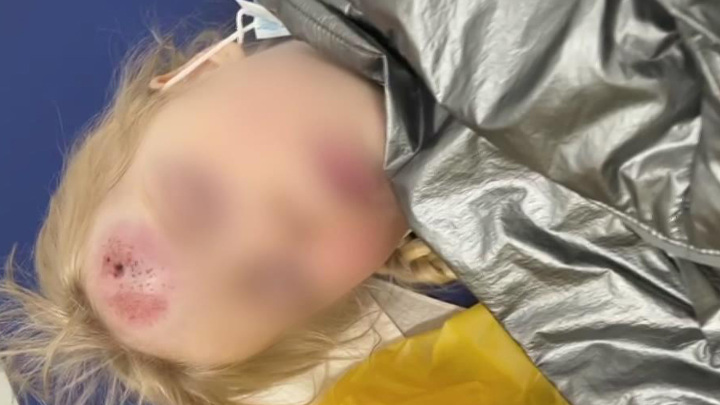 Вести-Москва. 4-летняя москвичка попала в реанимацию после наезда электросамоката